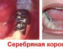 Kaj storiti, če ste alergični na zobno protezo Krono bo treba zamenjati v nekaj letih